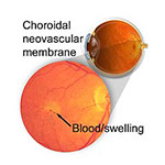 choroidal neovascular membrane