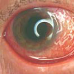 conjunctivitis