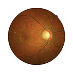 cystoid macular oedema