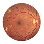 diabetic retinopathy
