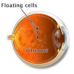 flashes and floaters