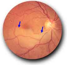 retinal artery occlusion