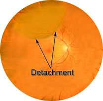 retinal detachment