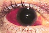 subconjunctival haemorrhage