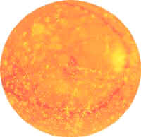 vitreous detachment asteroids