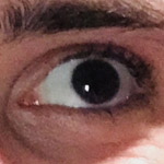 Strabismus thumbnail