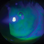 recurrent corneal erosion