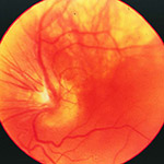 retrolental fibroplasia