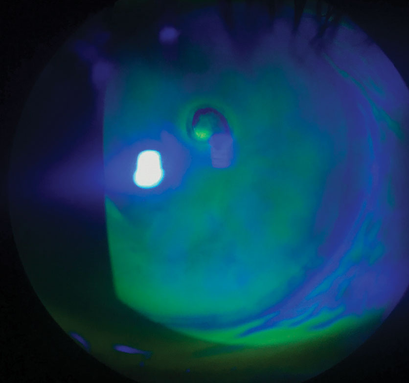 recurrent corneal erosion