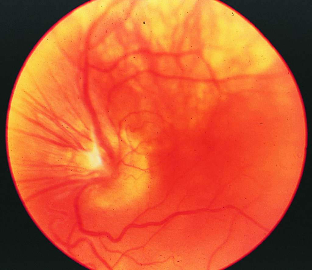retrolental fibroplasia